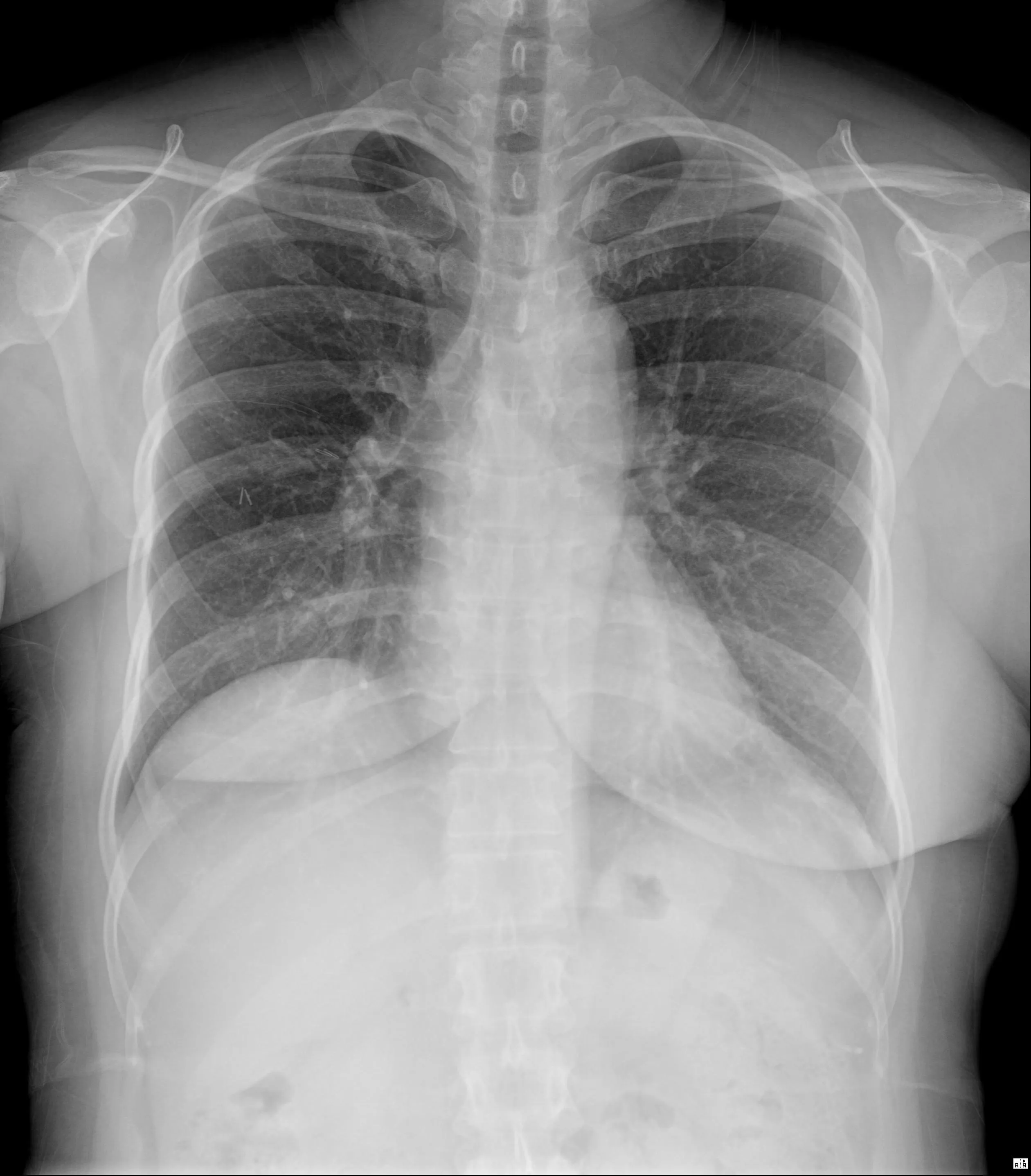 Chest BMD