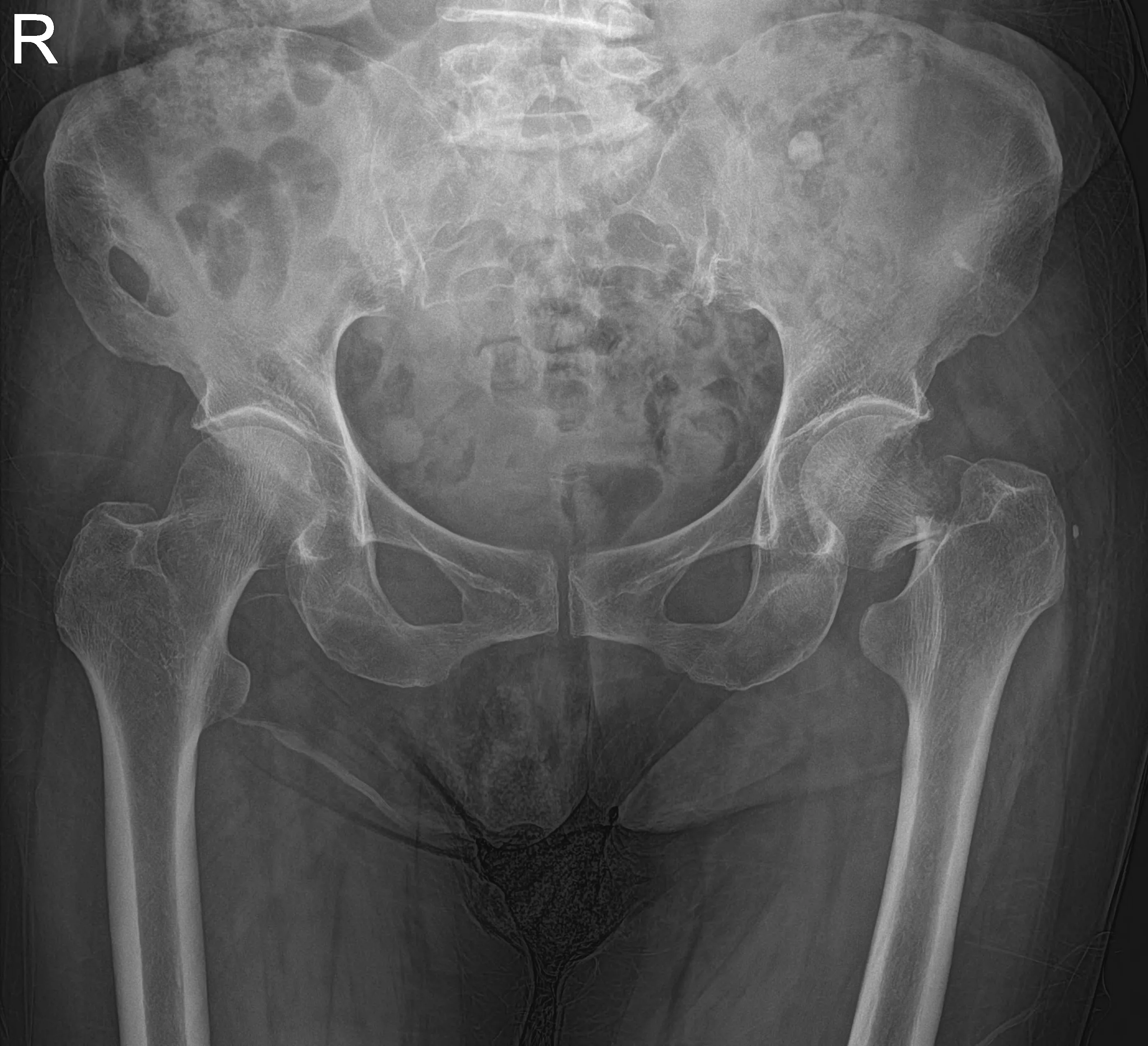 Hip Fracture