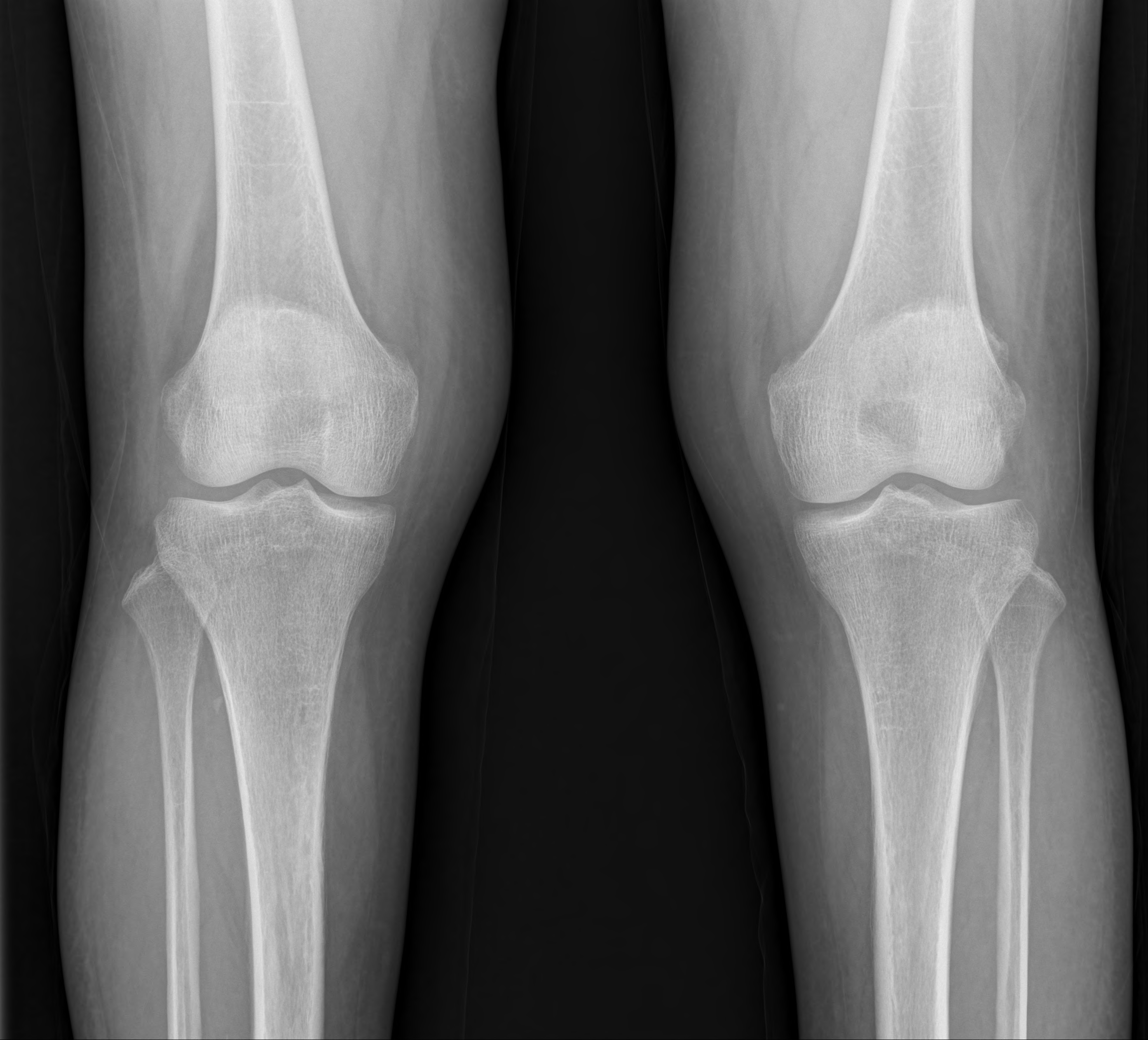 Knee AP