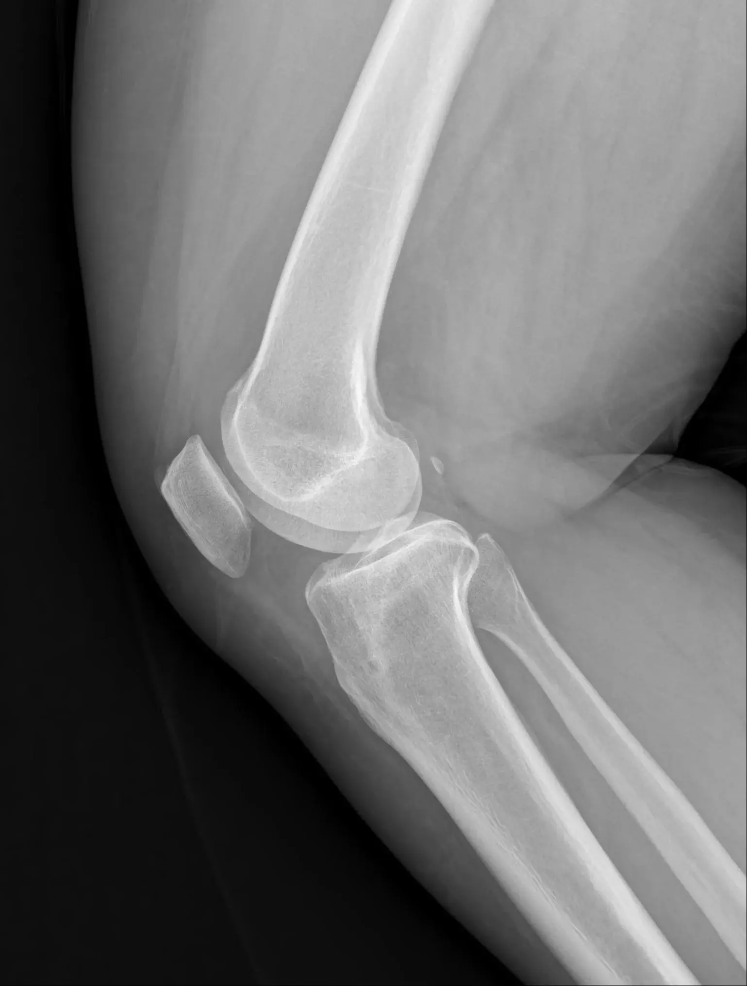 Knee LAT