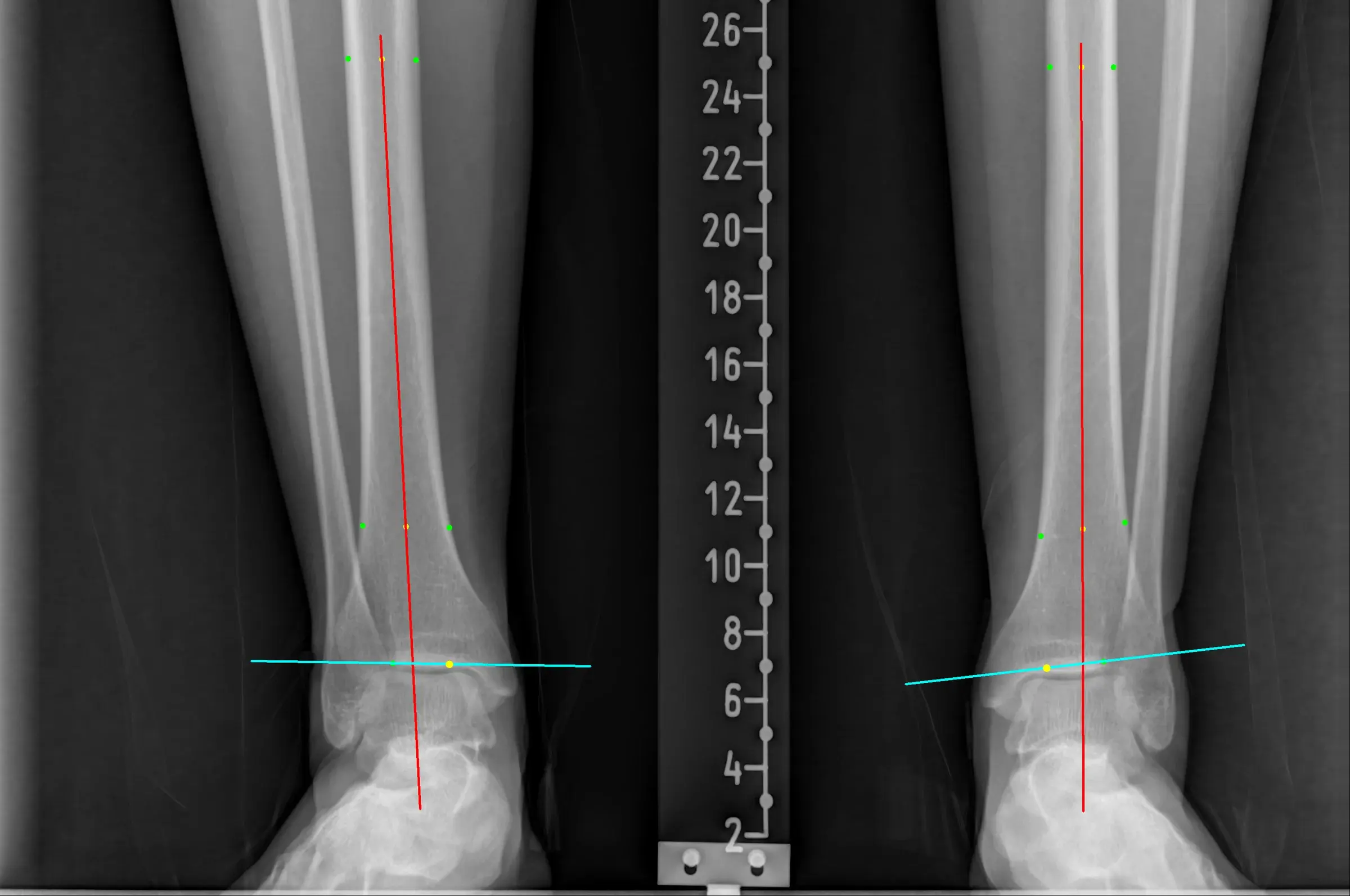 Ankle AP analysis