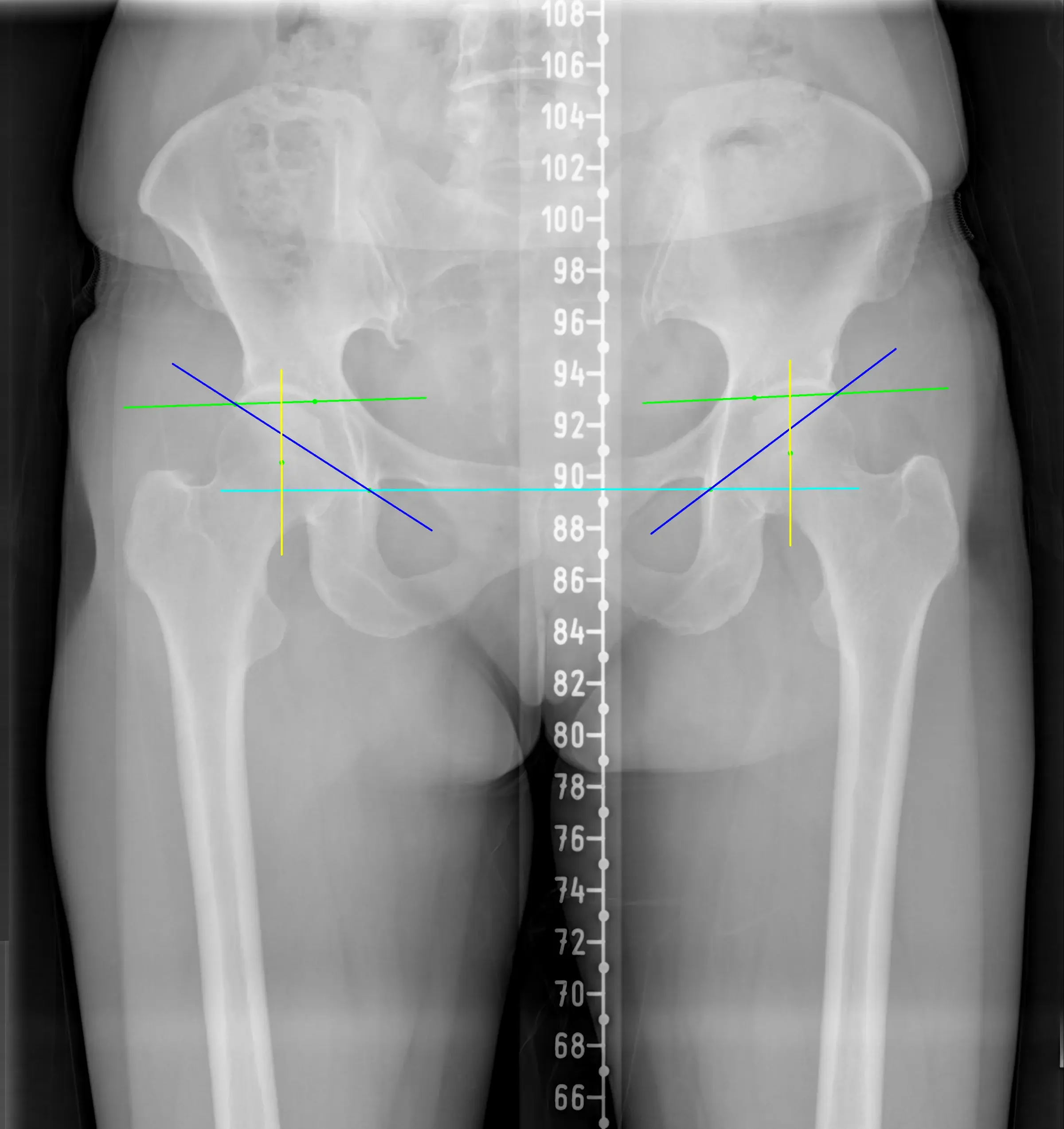 Hip AP analysis