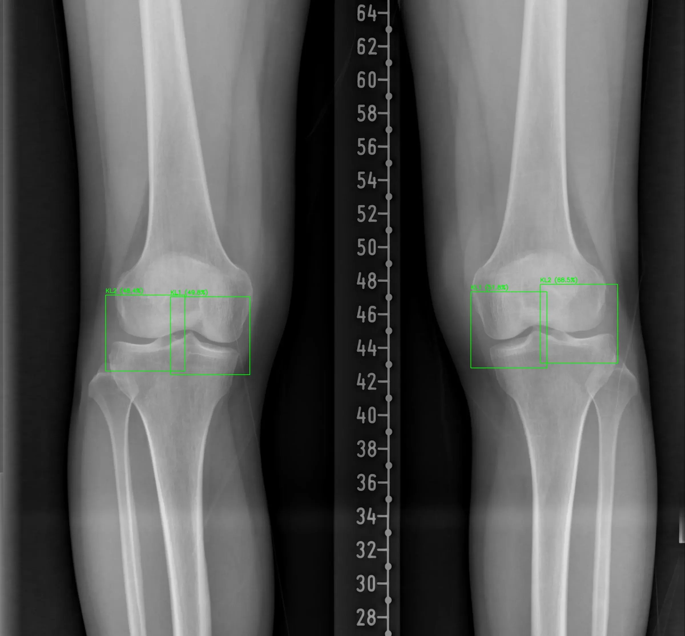 Knee AP analysis